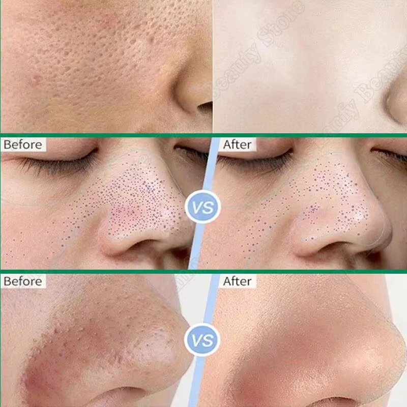 Salicylsäure Porenreinigungscr – Salicylic Acid Blackhead Remover Bewertung und Preis